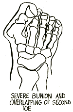 severe Bunion drawing