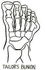 Drawing of Taylors Bunion