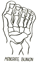 moderate Bunion drawing