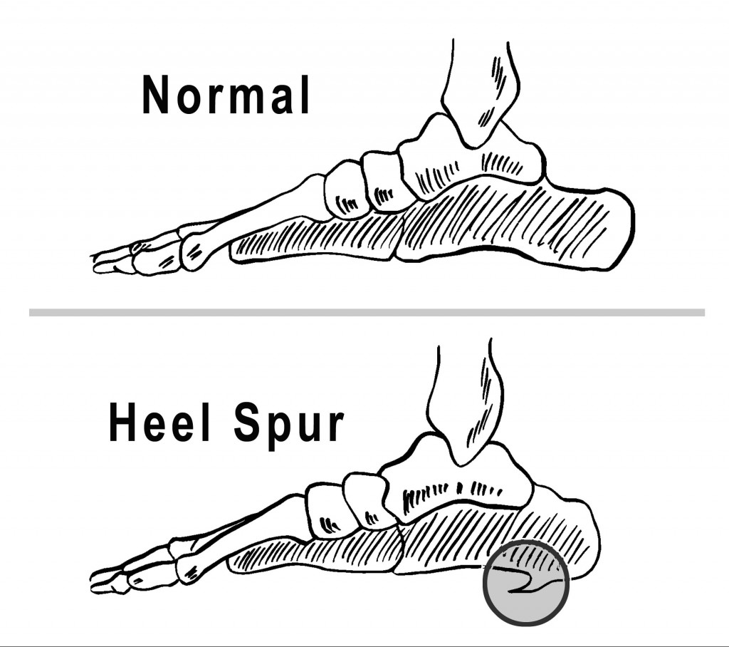 Drawing of heel, normal and with spur. Compliments of Dr. Burton S. Schuler, podiatrist, foot doctor, Panama City Fl