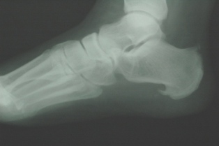 Calcaneal Spur