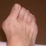 foot care : Panama City Panama City Beach fl, bunions, Dr. Burton S. Schuler, podiatrist 