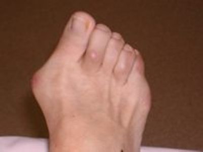 What treatment is available for foot bunions?