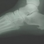 This is a heel spur, compliments of Dr. Burton S. Schuler podiatrist, foot doctor, Panama City Fl