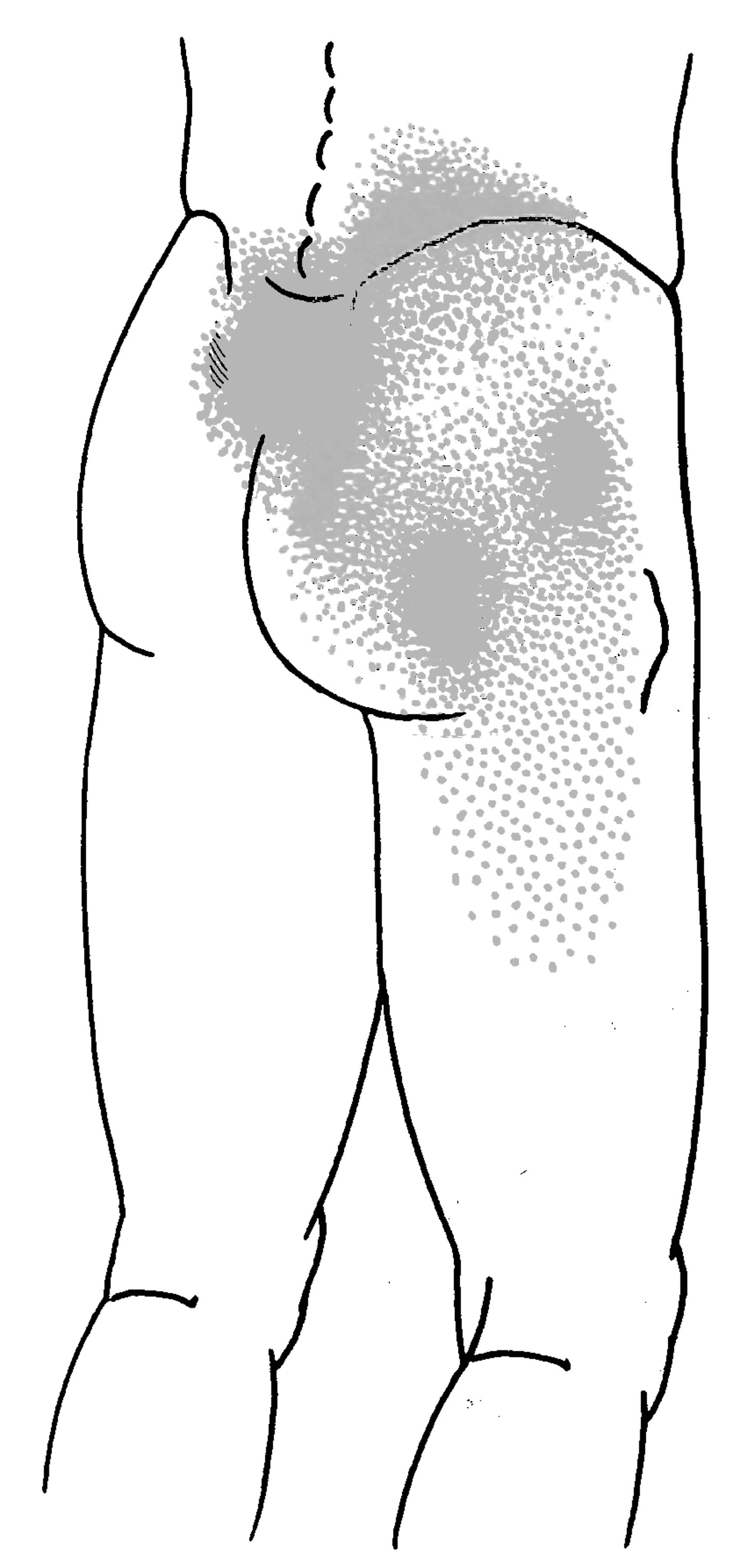 intermetatarsal neuroma