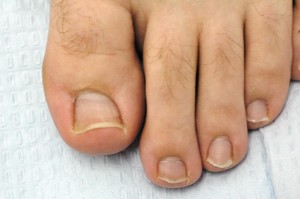 Morton's Toe, credit Dr. Burton S. Schuler, Panama City, Fl