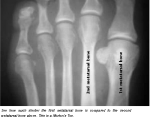 Xray of a Morton's Toe