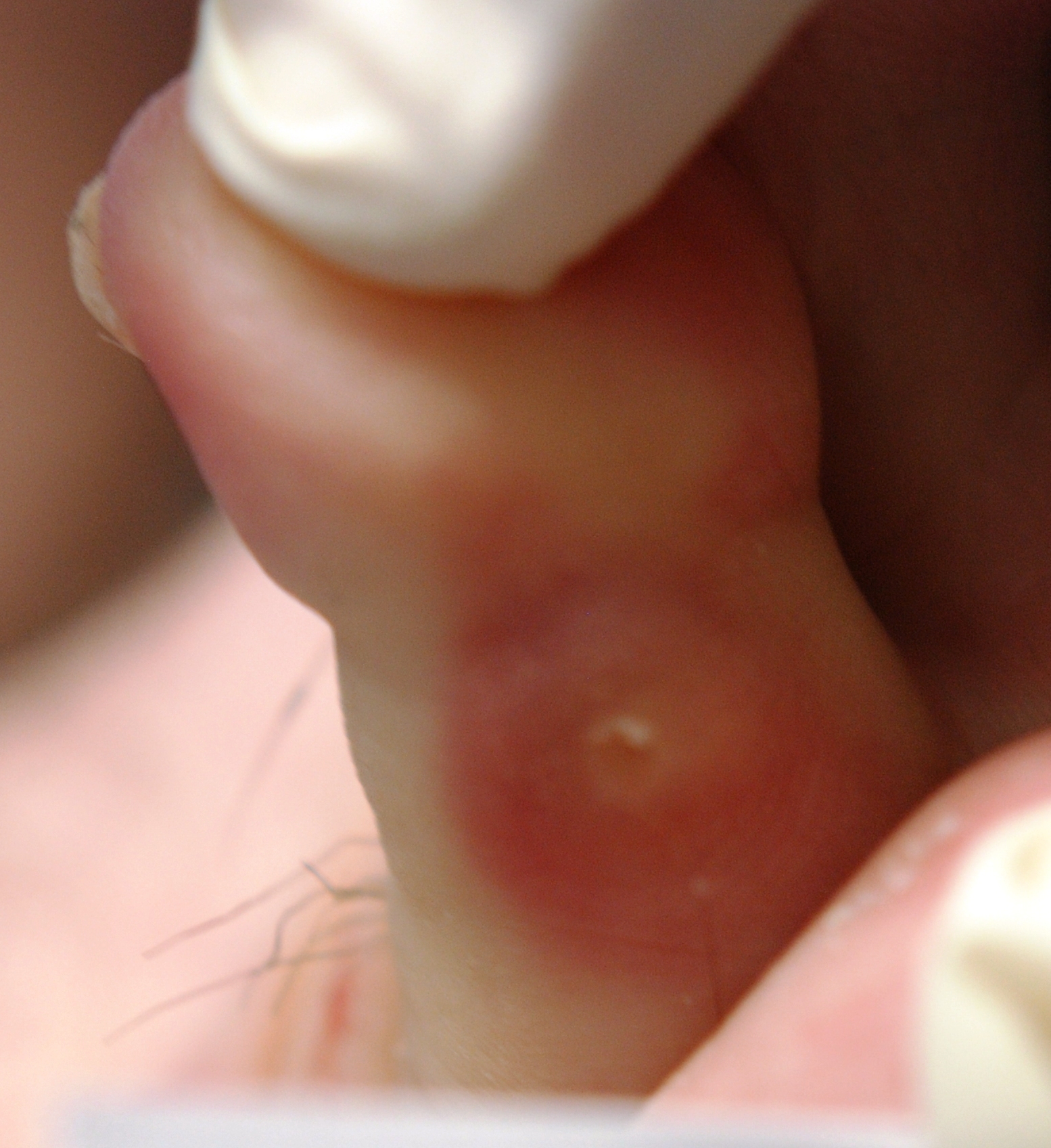 Hard corn between 4th and 5th toe 2025